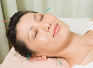 Hỏi đáp: đau đầu vận mạch có châm cứu được không?